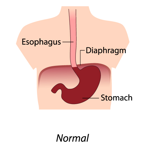 hiatus hernia normal stomach